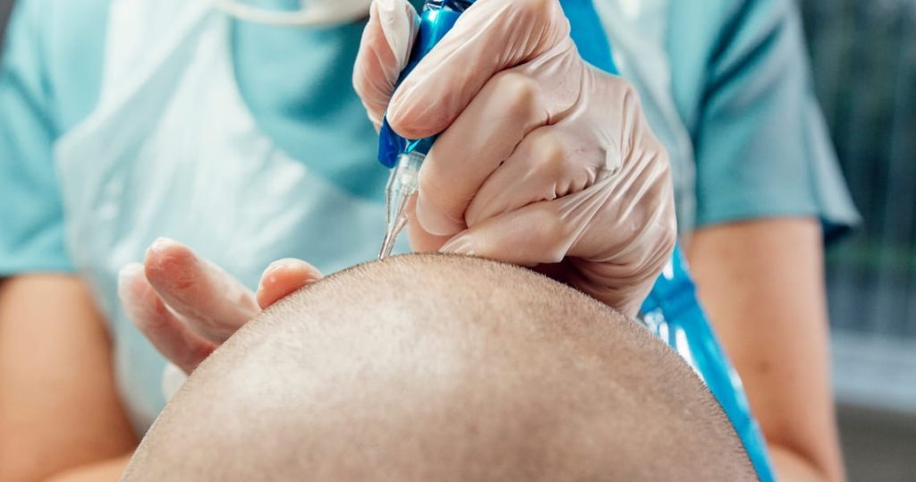 Micropigmentación capilar en Santander