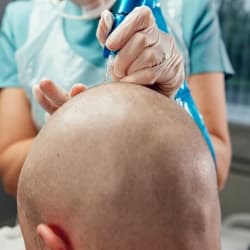 Técnica de micropigmentación capilar en Santander