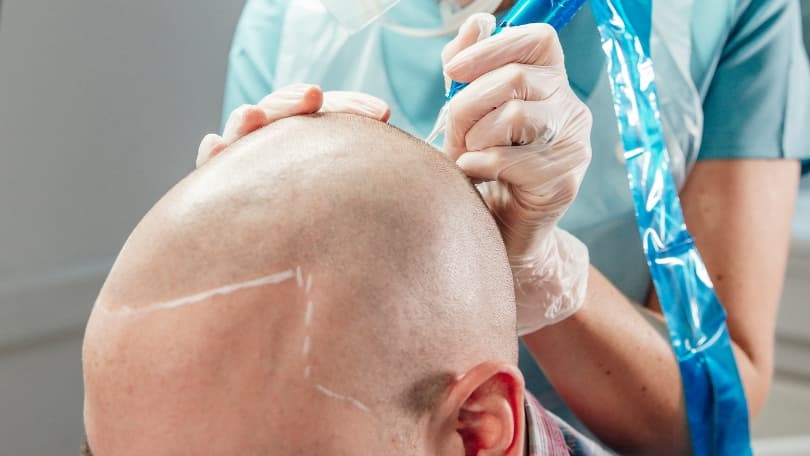 Técnica de micropigmentación capilar en Santander